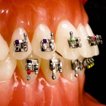 Bracket Biomim Ortho Classic Roth/M.B.T. Perfiles